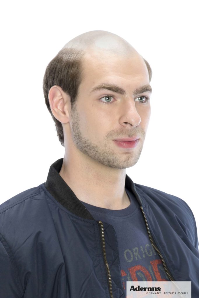 Intercoiffure Eder | Toupet für den Mann Intercoiffure Eder | 4 Mann vorher